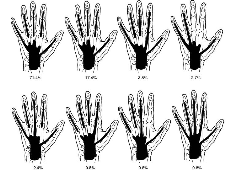 flexor tenosynovitis icd 10