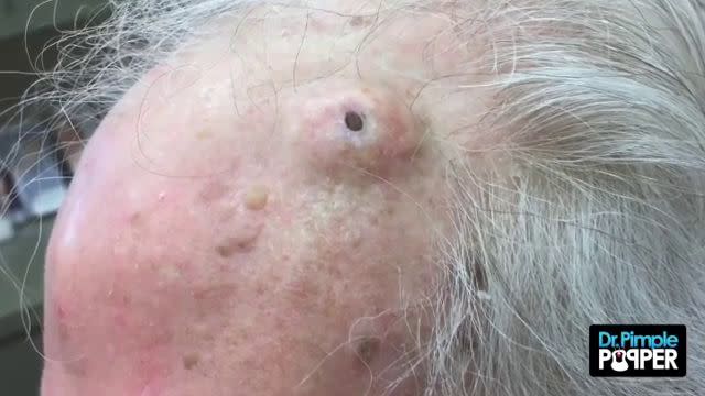 huge blackheads popped