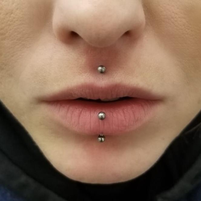 infected vertical labret