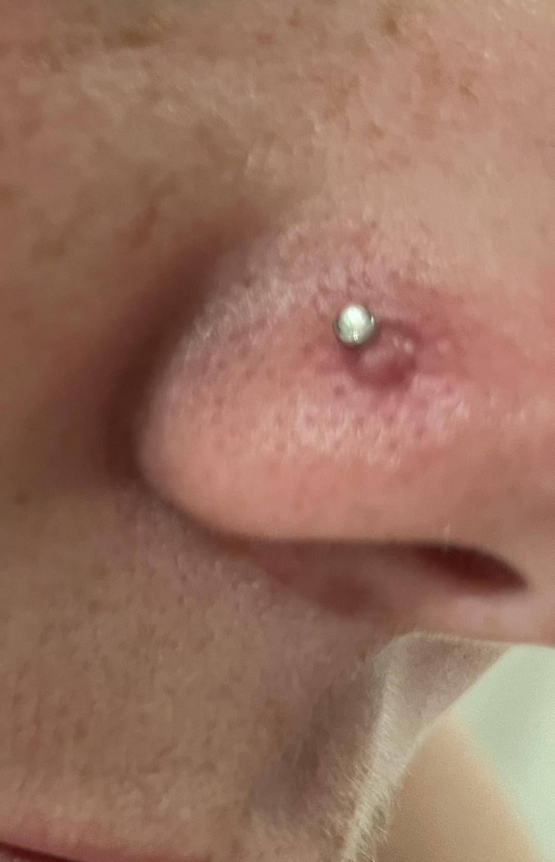 keloid nose piercing