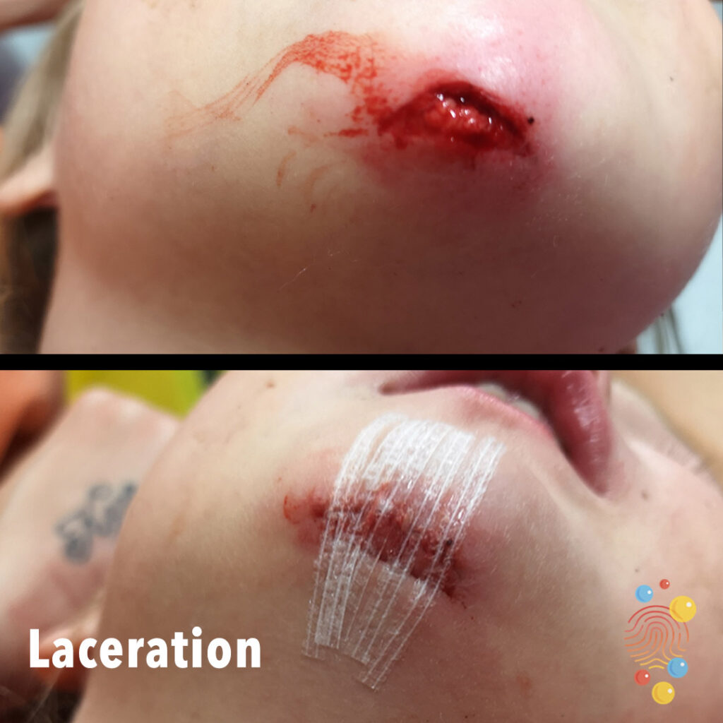 laceration chin icd 10