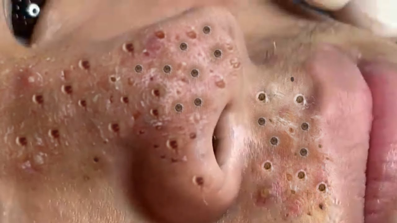 massive blackheads on nose and lips 2022