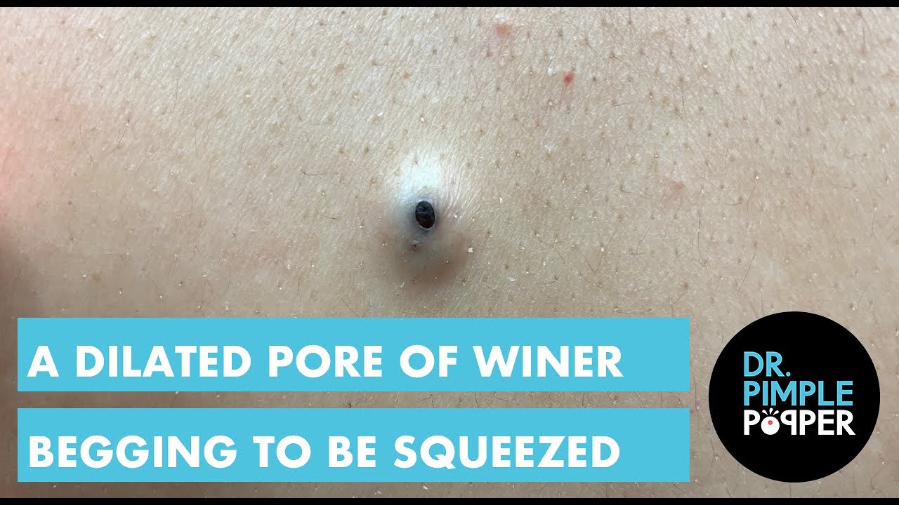 pore winer removal