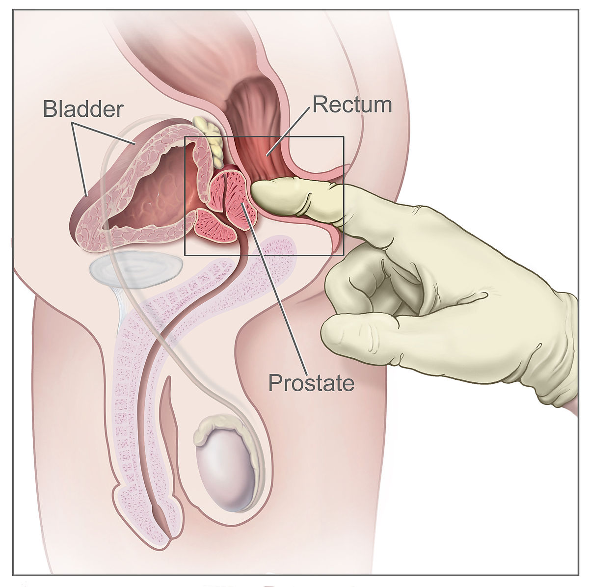 prostate massage therapy mayo clinic