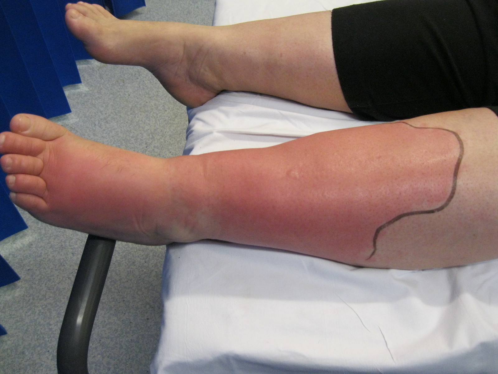 right lower extremity cellulitis icd 10