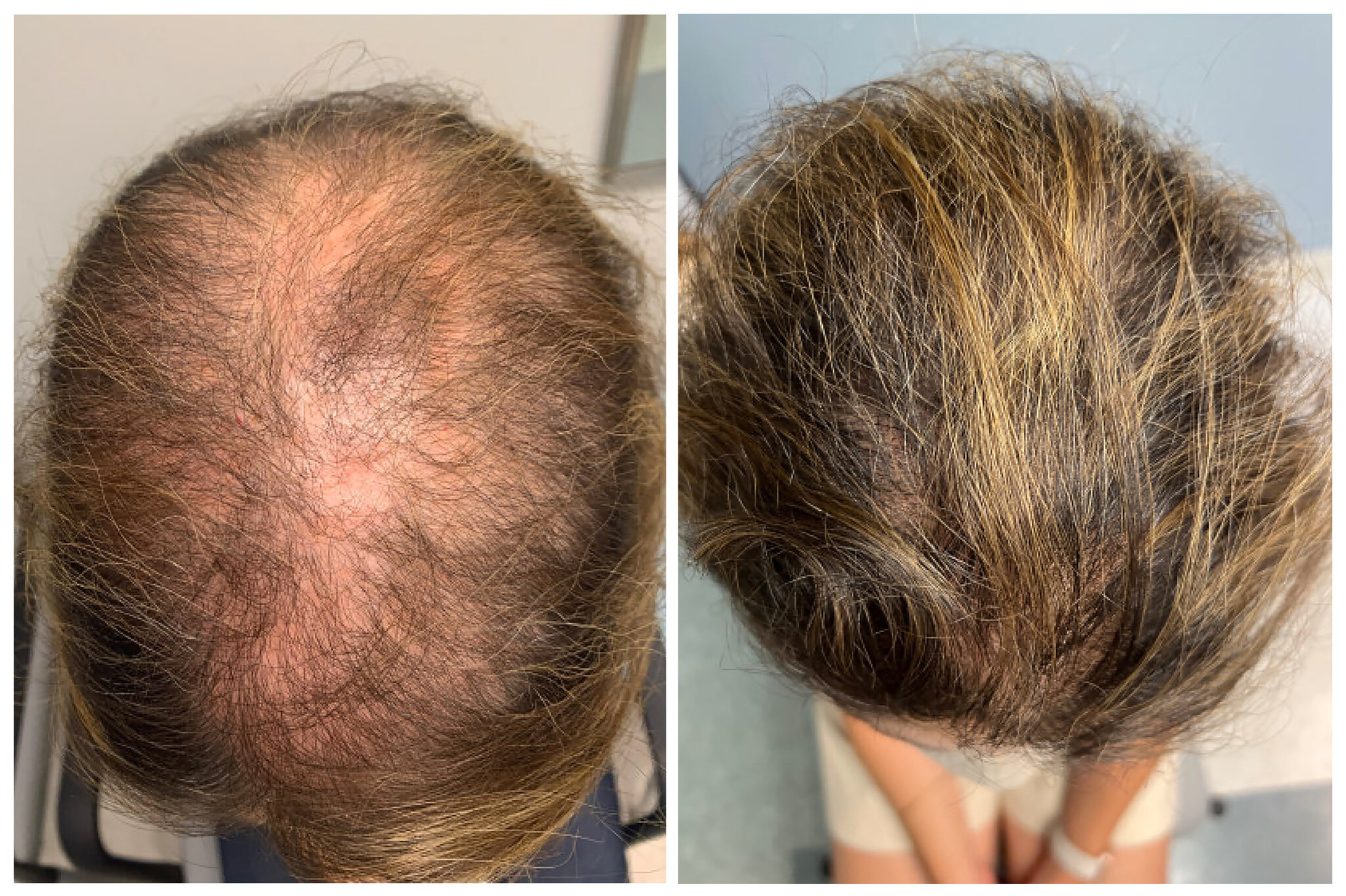 ritalin hair loss reddit