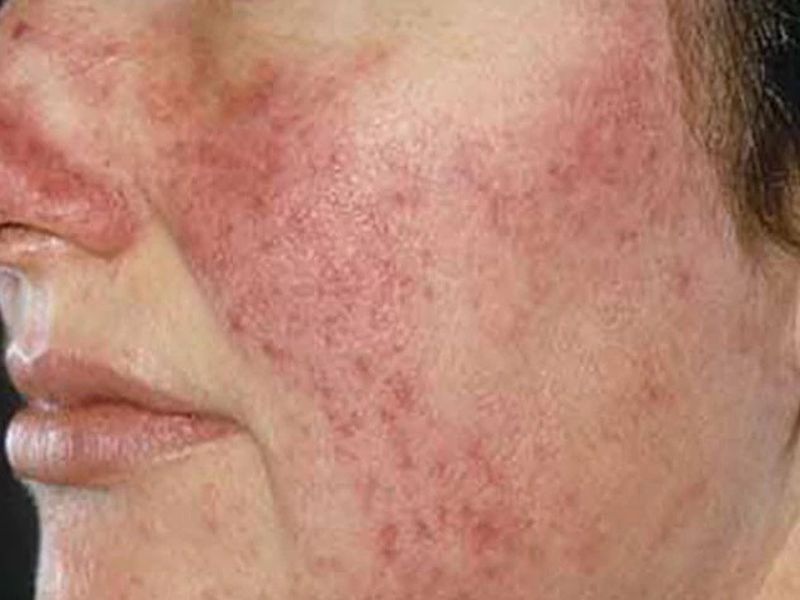 rosacea meaning in hindi