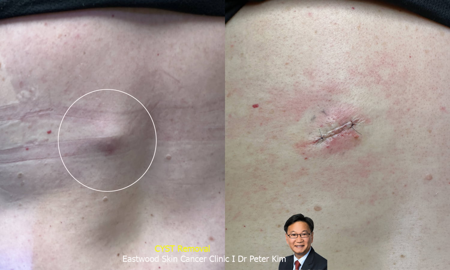 sebaceous cyst removal sydney