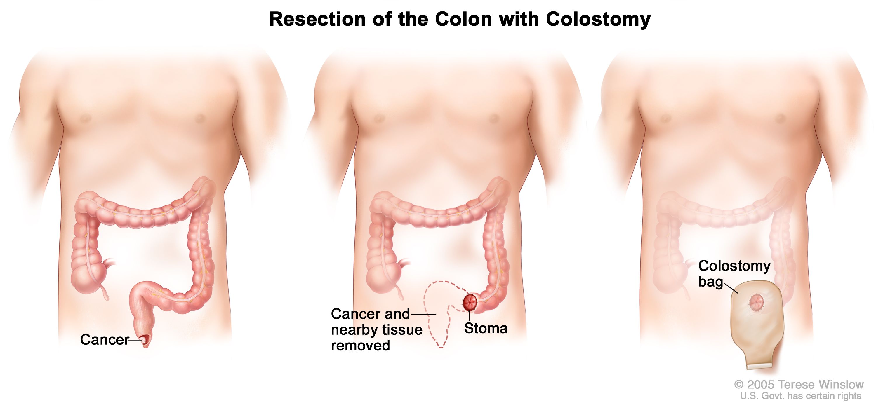 symptoms of anual cancer